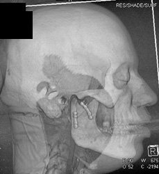 Repair of Fracture - CTisus CT Scan