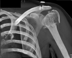 Humerus Fracture - CTisus CT Scan