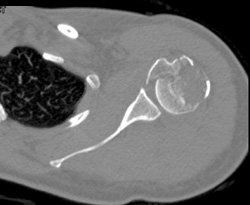 Humerus Fracture - CTisus CT Scan