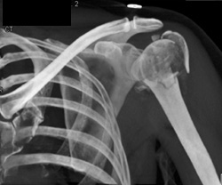 Humerus Fracture With 2 Types of VRT - CTisus CT Scan