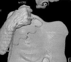 Iv in Hand - CTisus CT Scan