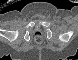 Congenital Dislocation of the Left Hip - CTisus CT Scan