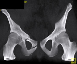 Pelvis Fracture and Repair - CTisus CT Scan