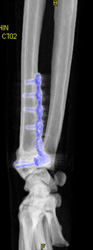 Reduction of Radial Fracture - CTisus CT Scan