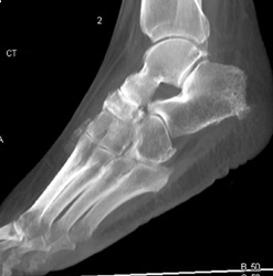 Calcaneal Fracture - CTisus CT Scan