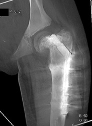 Open Reduction Internal Fixation (ORIF) for Slipped Capital Femoral Epiphysis (SCFE) - CTisus CT Scan