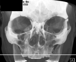 Mandubular and Orbital Fractures - CTisus CT Scan