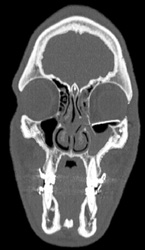 Orbital Fracture - CTisus CT Scan