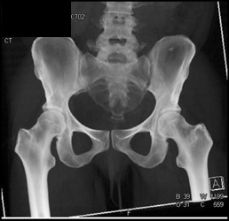 Widened Left SI Joint - CTisus CT Scan