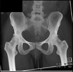 Early Infection Left SI Joint - CTisus CT Scan