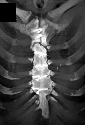 Non Union Sternum - CTisus CT Scan