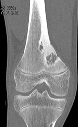 NOF - CTisus CT Scan