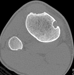 Nonossifying Fibroma - CTisus CT Scan