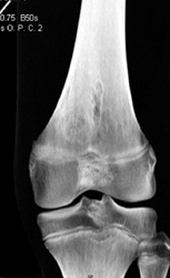 NOF in 3D - CTisus CT Scan