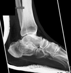 Calcaneal Fracture - CTisus CT Scan