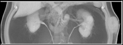 Renal Cell Carcinoma With Subcutaneous Metastases - CTisus CT Scan