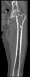 Chondrosarcoma - CTisus CT Scan