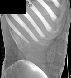 Abdominal Wall Bleed - CTisus CT Scan