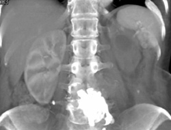 Metastases to Spine - CTisus CT Scan