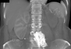 Lytic Metastases - CTisus CT Scan