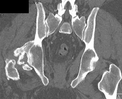 Heterotopic Ossification - CTisus CT Scan