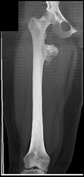 Chondrosarcoma - CTisus CT Scan