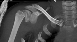 Humerus Fracture - CTisus CT Scan