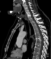 Collapsed Vertebral Bodies - CTisus CT Scan