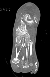 Osteoarthritis - CTisus CT Scan