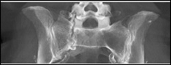 Stress Fracture Sacrum - CTisus CT Scan