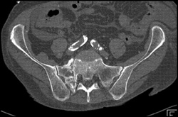 Stress Fracture - CTisus CT Scan