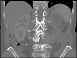 Destructive Lesion With Soft Tissue Mass - CTisus CT Scan