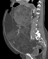 Liposarcoma - CTisus CT Scan