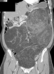 Liposarcoma - CTisus CT Scan