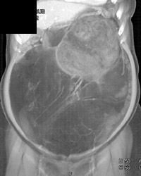 Liposarcoma - CTisus CT Scan