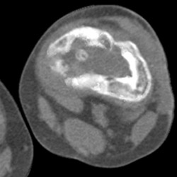 Infection at Site of Prior Trauma - CTisus CT Scan