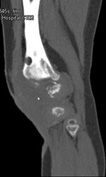 Infection at Site of Prior Trauma With Prior Open Reduction Internal Fixation (ORIF) - CTisus CT Scan