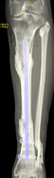 Healing Fractures - CTisus CT Scan