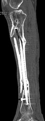 Intramedullary Rods - CTisus CT Scan