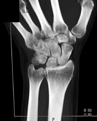 3D Carpal Bones With Subtle Scaphiod Fracture - CTisus CT Scan