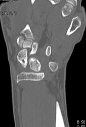 Cyst in Scaphiod From Prior Trauma - CTisus CT Scan