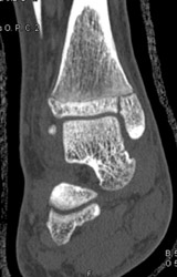 Fracture Through Epiphysis and Into Articular Surface - CTisus CT Scan