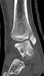 Fracture Through Epiphysis and Into Articular Surface - Musculoskeletal ...