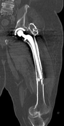 Failed Total Hip Replacement (THR) (distally) - CTisus CT Scan