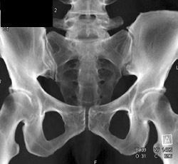 Infected Left SI Joint - CTisus CT Scan