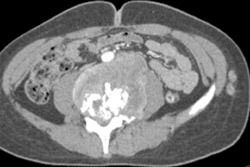 Metastatic Neuroblastoma Including Subcutaneous and Muscle Metastases - CTisus CT Scan