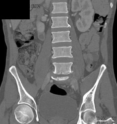 Infection at L5-s1 - CTisus CT Scan