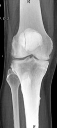 Patellar Fracture - CTisus CT Scan