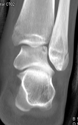 Fibular and Talus Fractures - CTisus CT Scan