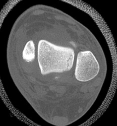 Talar Fracture - CTisus CT Scan